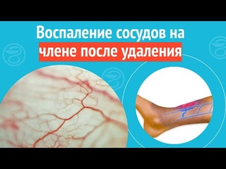 😕 Воспаление сосудов на члене после удаления. Клинический случай №1088