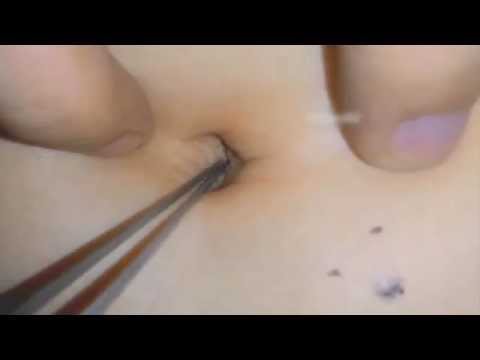 Huge Blackhead Blackhead Removal Inside Belly