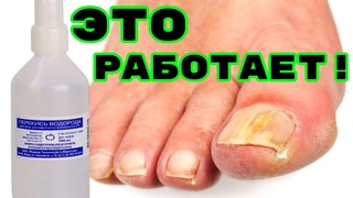 КАК РЕАЛЬНО ВЫЛЕЧИТЬ ГРИБОК НОГТЕЙ НА НОГАХ НАРОДНЫМ СРЕДСТВОМ! Без мазей и таблеток!
